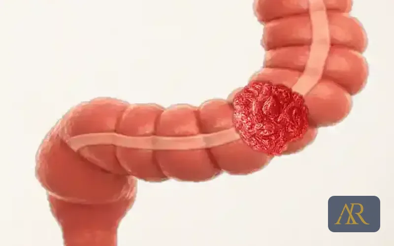 Colectomia