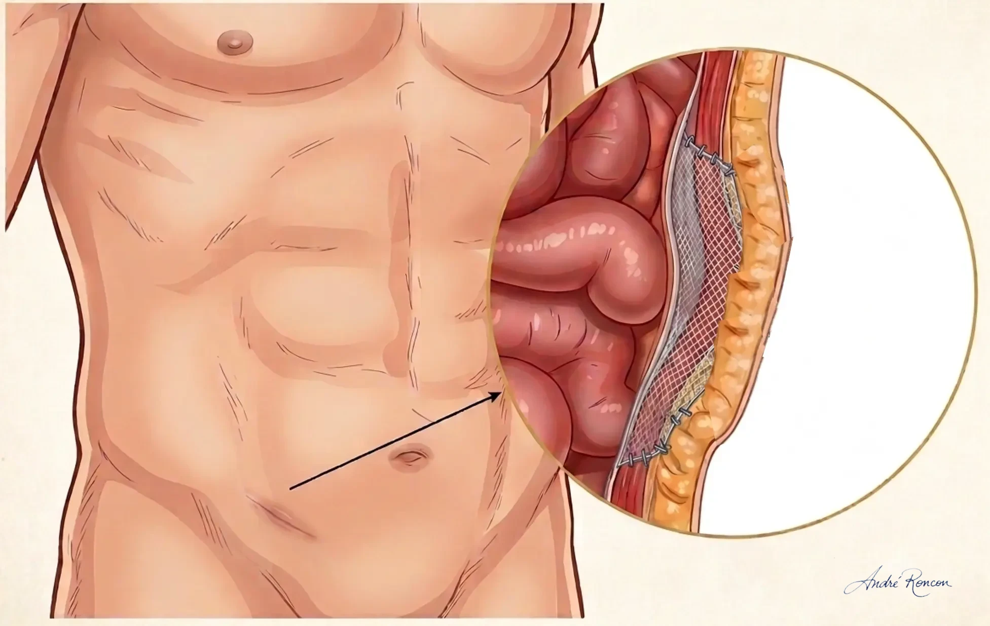 herniorrafia inguinal com uso de tela inabsorvível