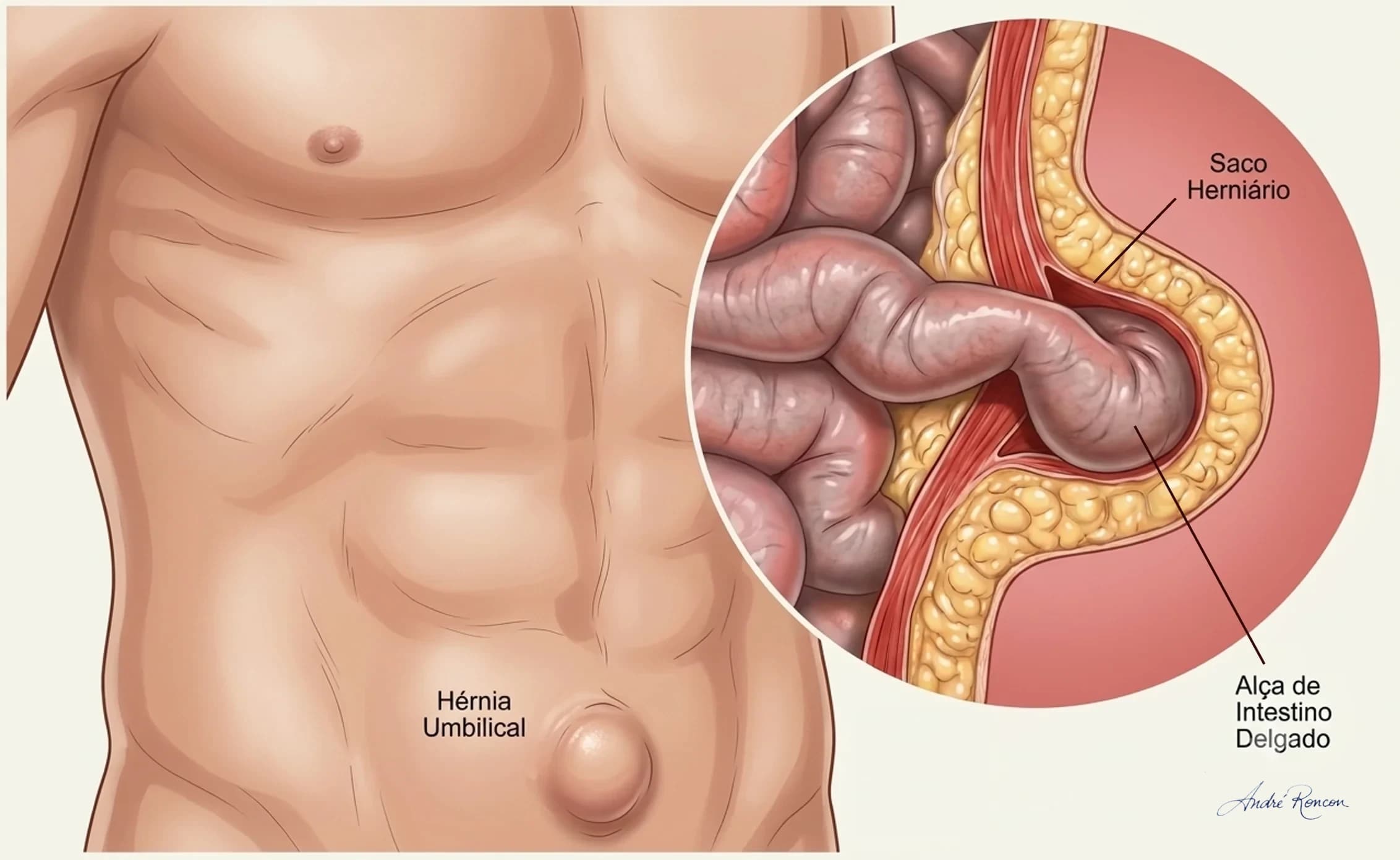 hérnia umbilical: visão interna e externa